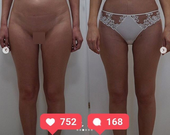 Фото пациентки доктора Пенаева до и после Vaser-липосакции