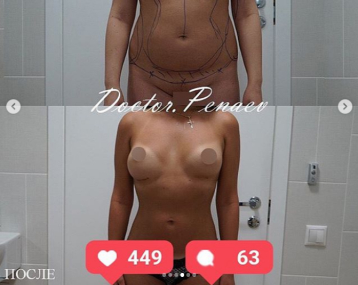 Фото пациентки доктора Пенаева до и после липотрансформации