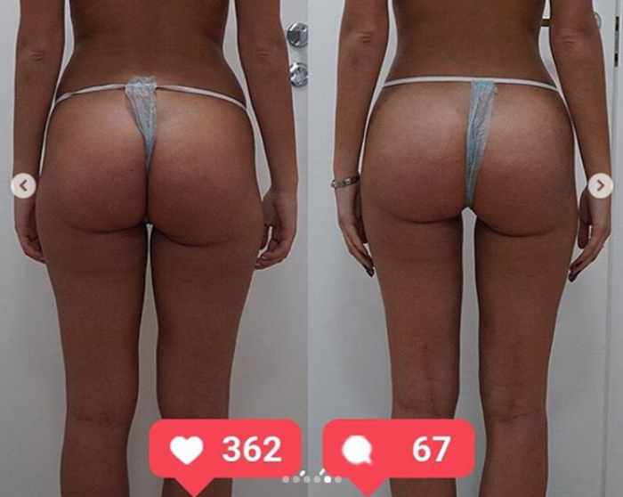 Фото пациентки доктора Пенаева до и после мультизональной VASER-липосакции