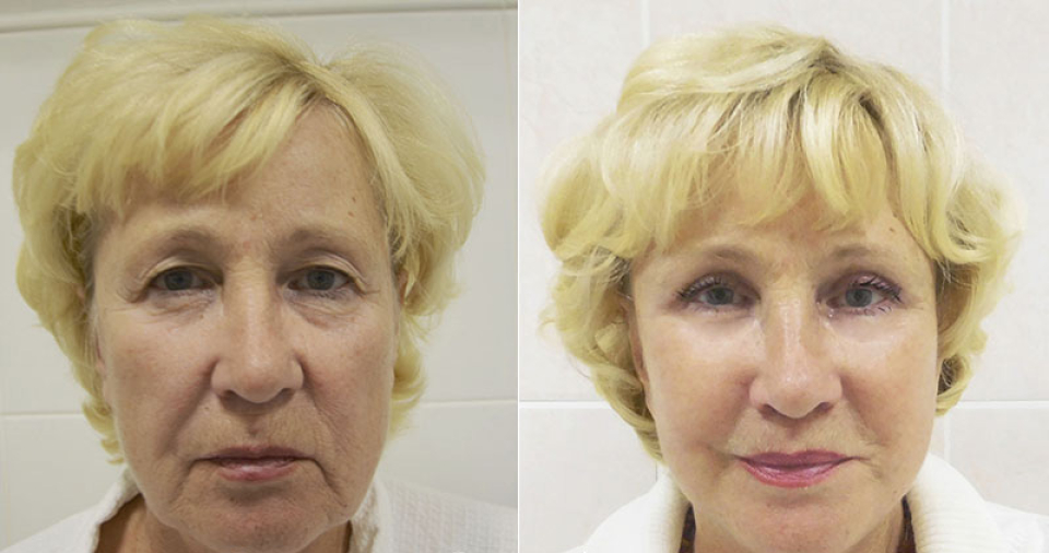 Пациентка до и после фейслифтинга у пластического хирурга Ольги Ованесовой