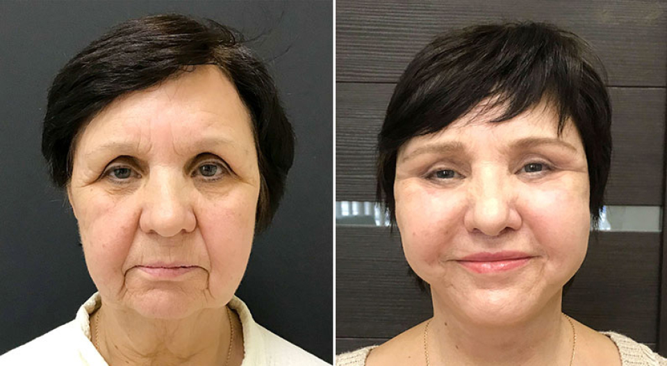 Пациентка до и после фейслифтинга у Ольги Ованесовой