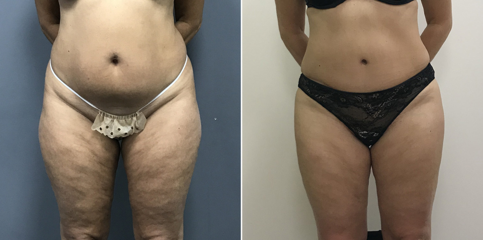 Дмитрий Рябцев абдоминопластика фото