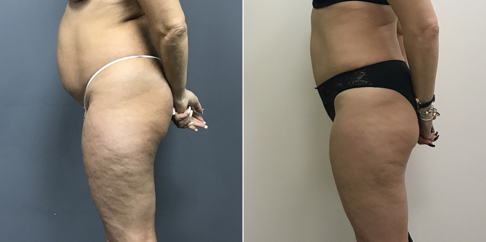 Дмитрий Рябцев абдоминопластика фото