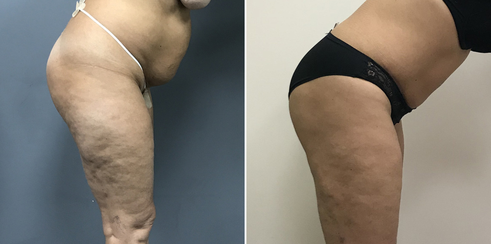 Дмитрий Рябцев абдоминопластика фото