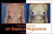 Борис Мирзоян. Фото до и после мастопексии