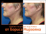 Борис Мирзоян. Фото до и после шейно-лицевой подтяжки