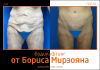 Борис Мирзоян. Фото до и после круговой подтяжки тела