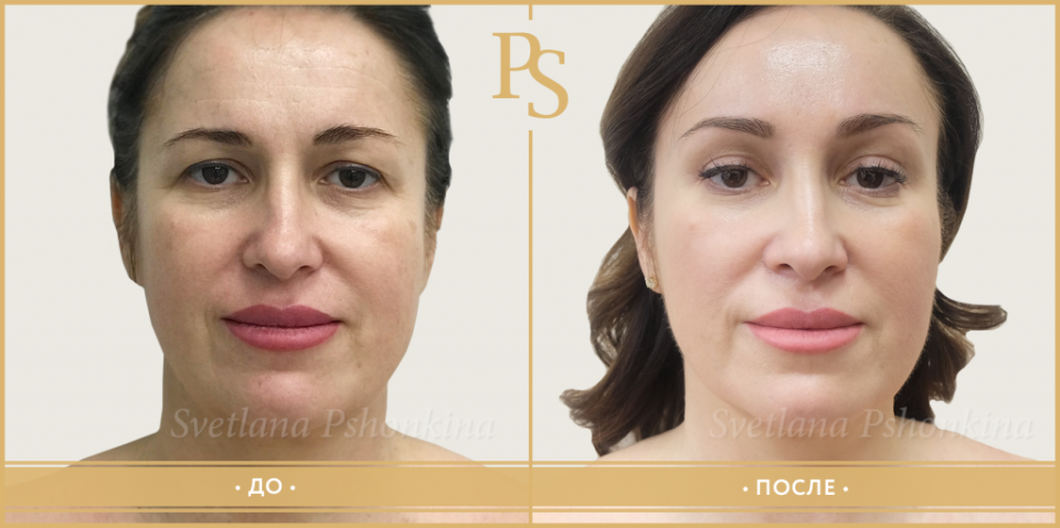 Пациентка доктора Пшонкиной до и после RF- подтяжки лица