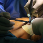 Увеличение груди: история от и до из первых уст