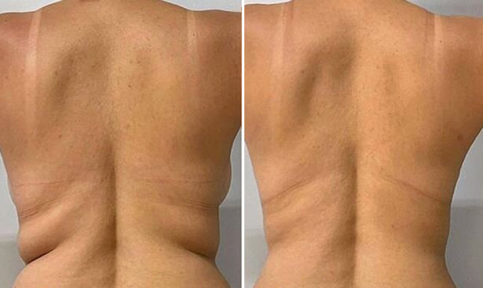 Фото до и после процедуры криолиполиза