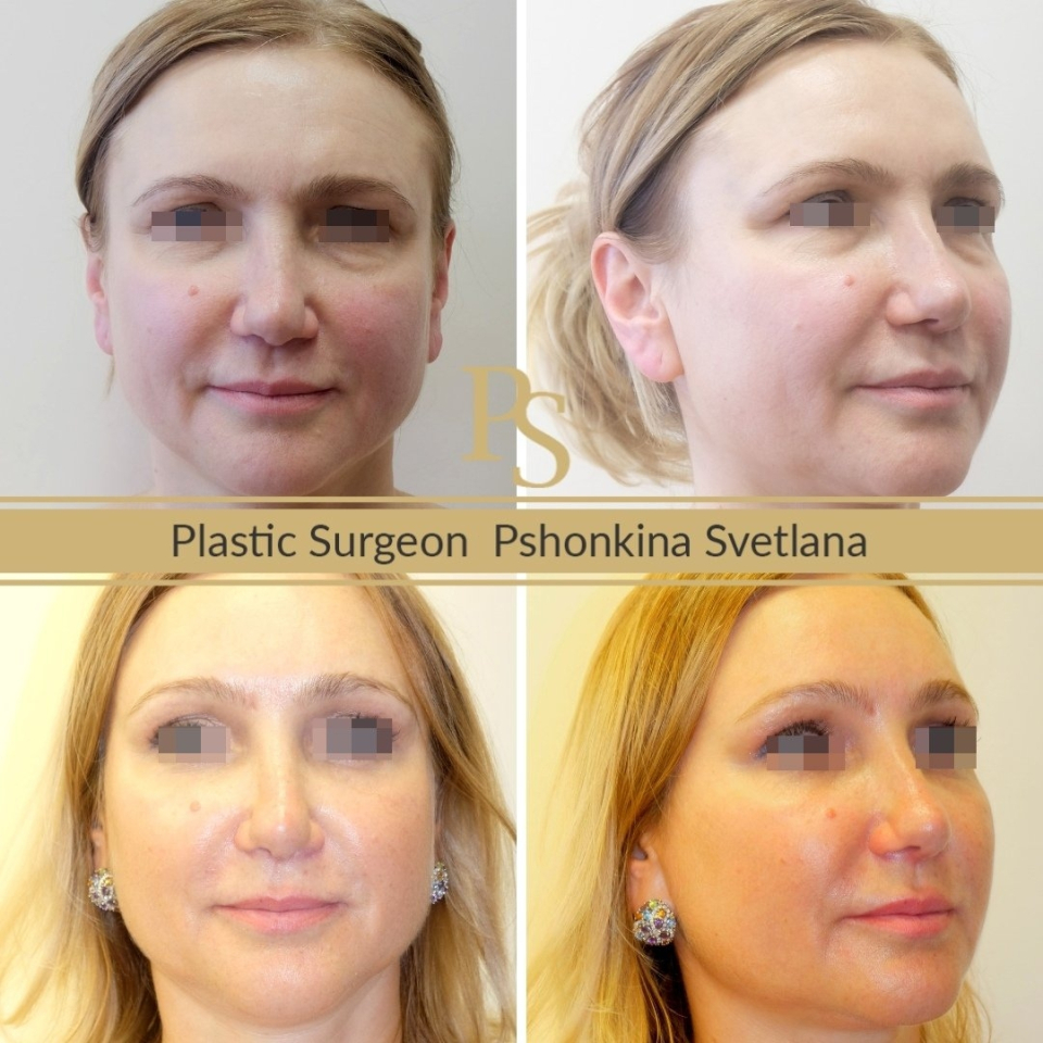 Фото пациента до и после Визаж Лифта лица у доктора Пшонкиной