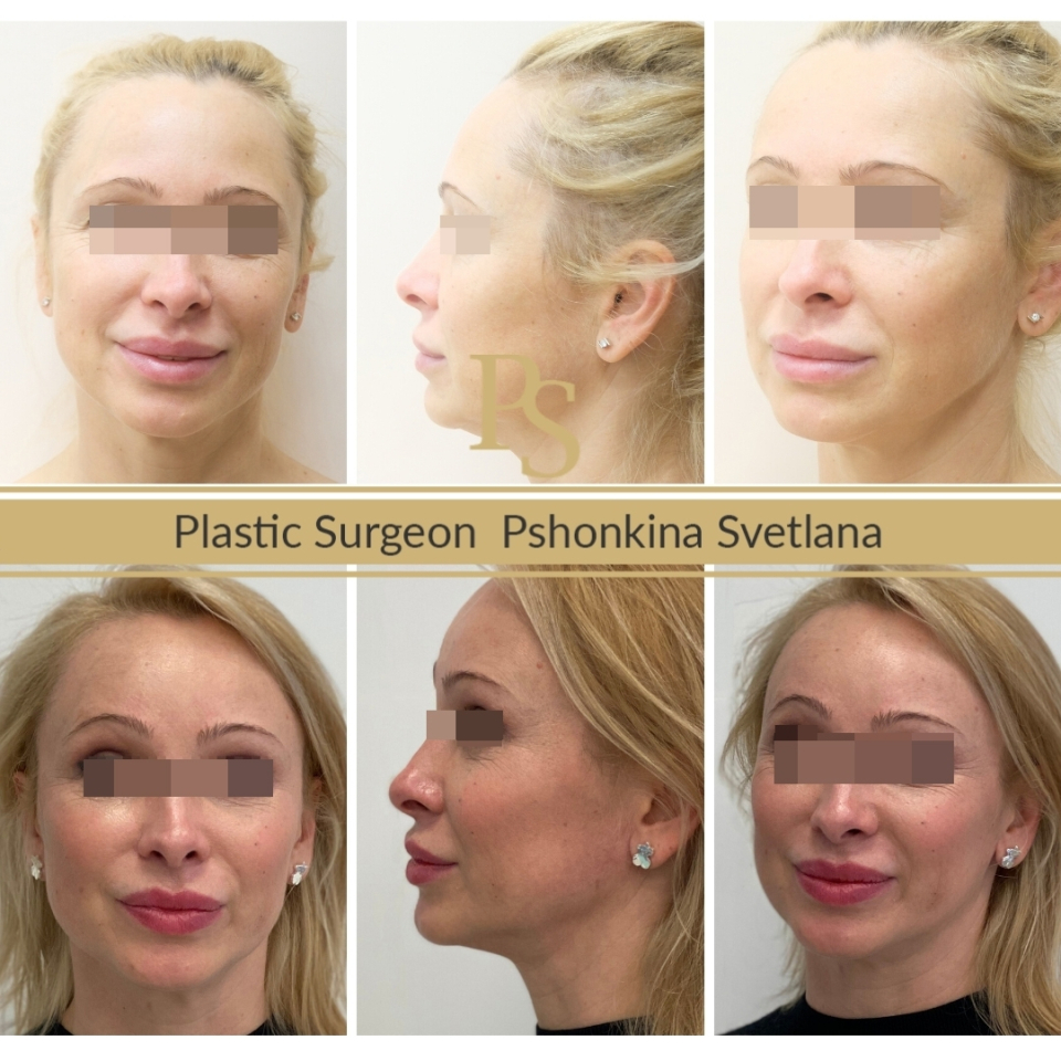 Фото пациента до и после эндолифтинга лица у доктора Пшонкиной