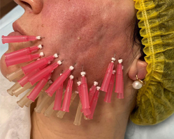 Тредлифтинг у пациентки доктора Галины Хрущ