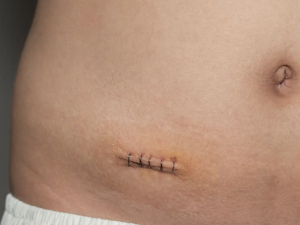 Шрамы и келоиды: способы устранения проблемы