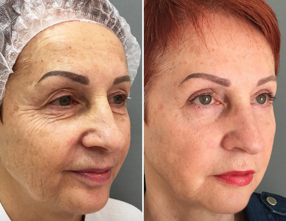 Марина Четверикова блефаропластика