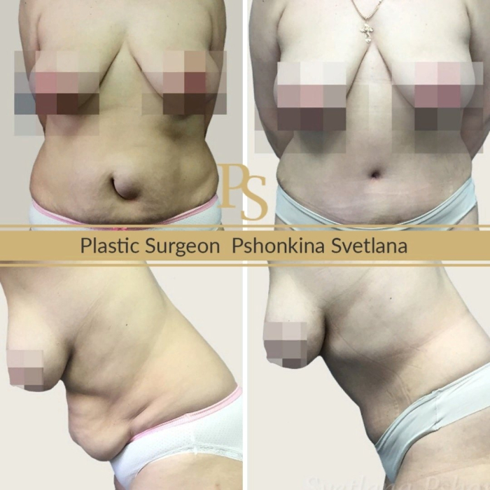 Абдоминопластика с удалением пупочной грыжи