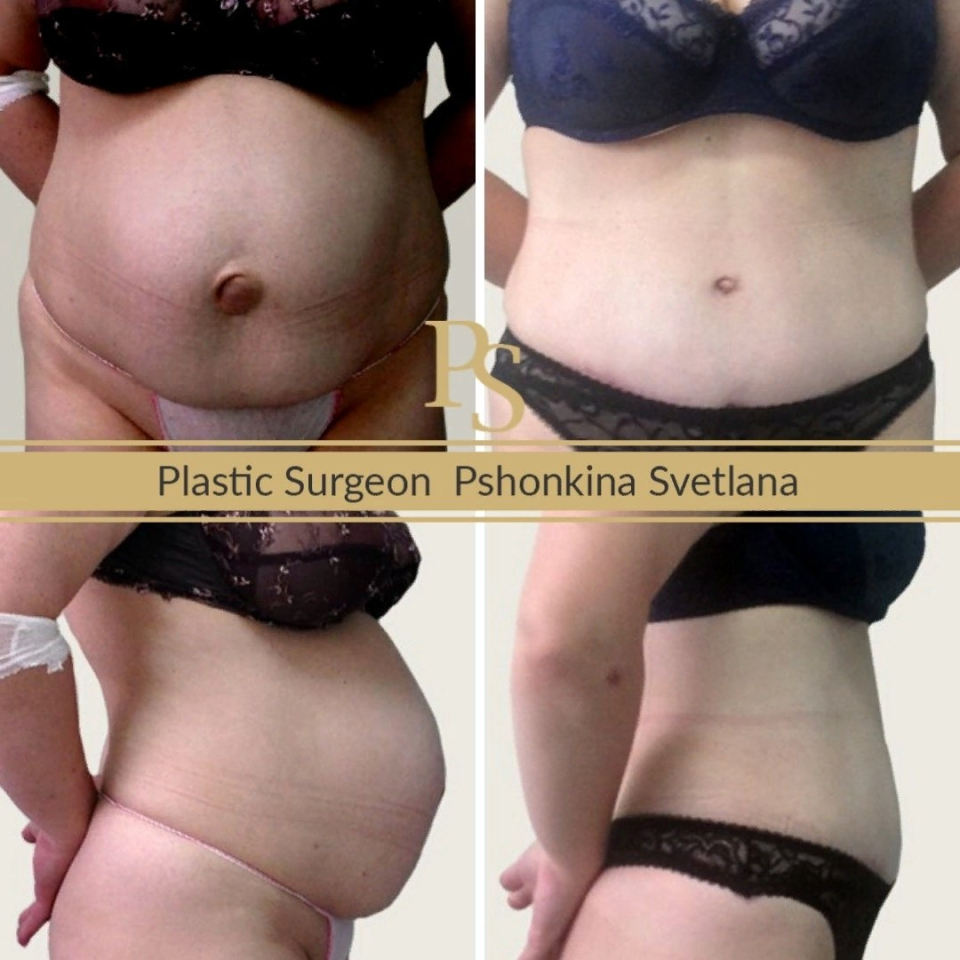 Абдоминопластика с удалением пупочной грыжи