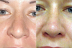Фото до и после ринопластики у доктора Светланы Пшонкиной