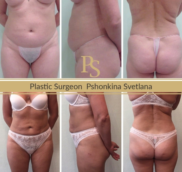 Фото до и после липосакции у пластического хирурга Светланы Пшонкиной