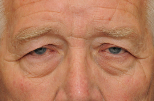 Пример блефароптоза