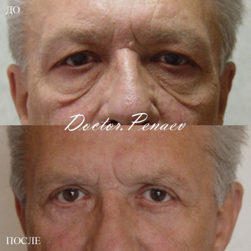Пациент доктора Арслана Пенаева после пластики век
