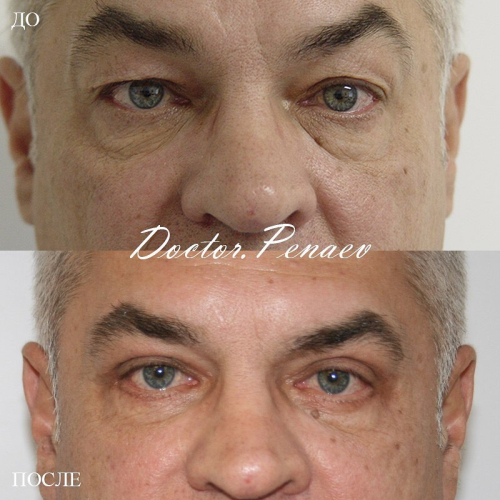 Пациент доктора Пенаева после блефаропластики