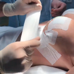 Подтяжка груди и SMAS-лифтинг лица