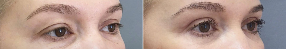 верхняя блефаропластика Марина Четверикова