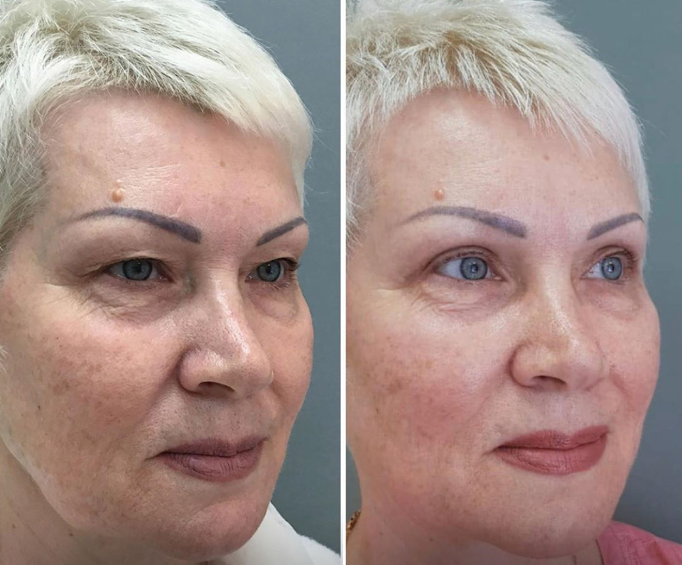 верхняя блефаропластика Марина Четверикова
