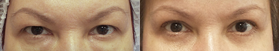 блефаропластика Санкт-Петербург Марина Четверикова