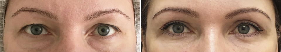 верхняя и нижняя блефаропластика Марина Четверикова