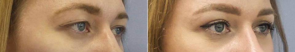 блефаропластика Санкт-Петербург