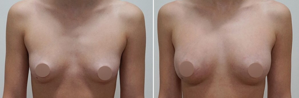 Пациентка, 25 лет. Выполнен липотрансфер груди. Результат через 6 месяцев после операции