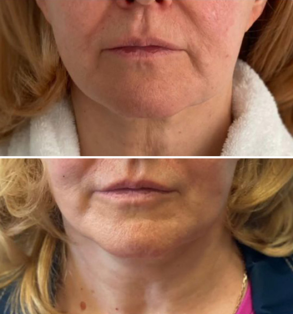 эндоскопическая подтяжка Светлана Пшонкина