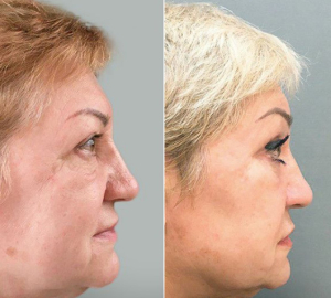 подтяжка лица Марина Четверикова