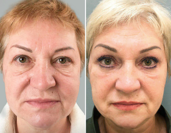 Четверикова подтяжка лица