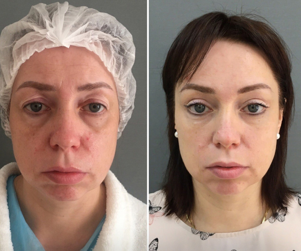 Пациентка до и после комплексного омоложения у доктора Марины Четвериковой