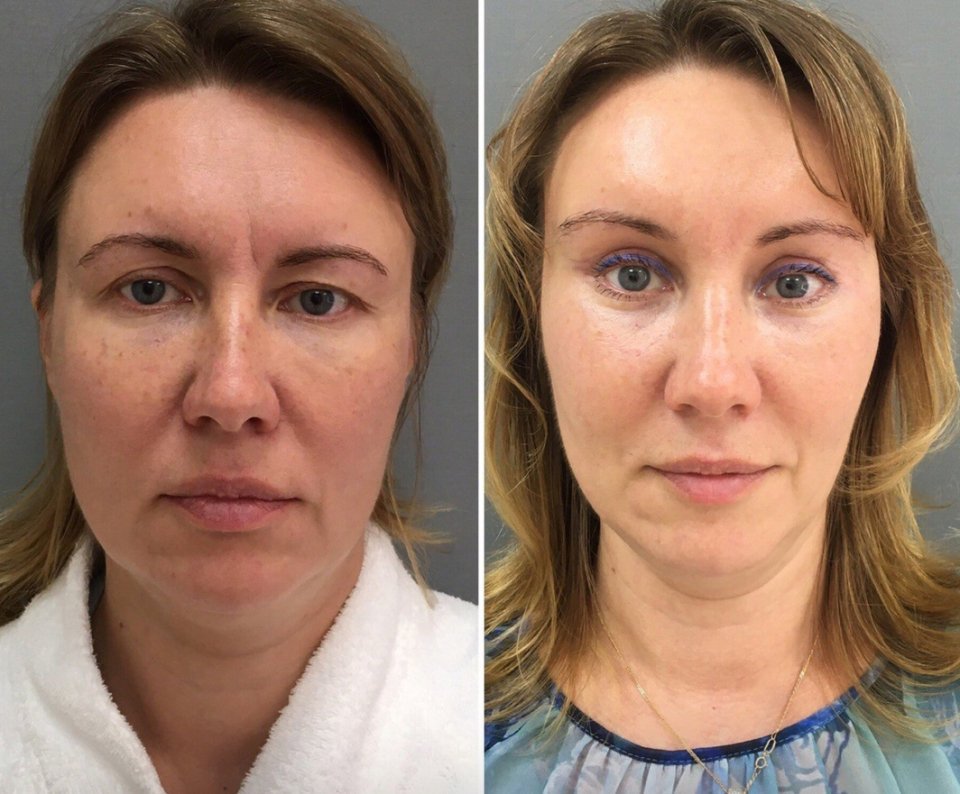 Пациентка до и после комплексного омоложения у доктора Четвериковой