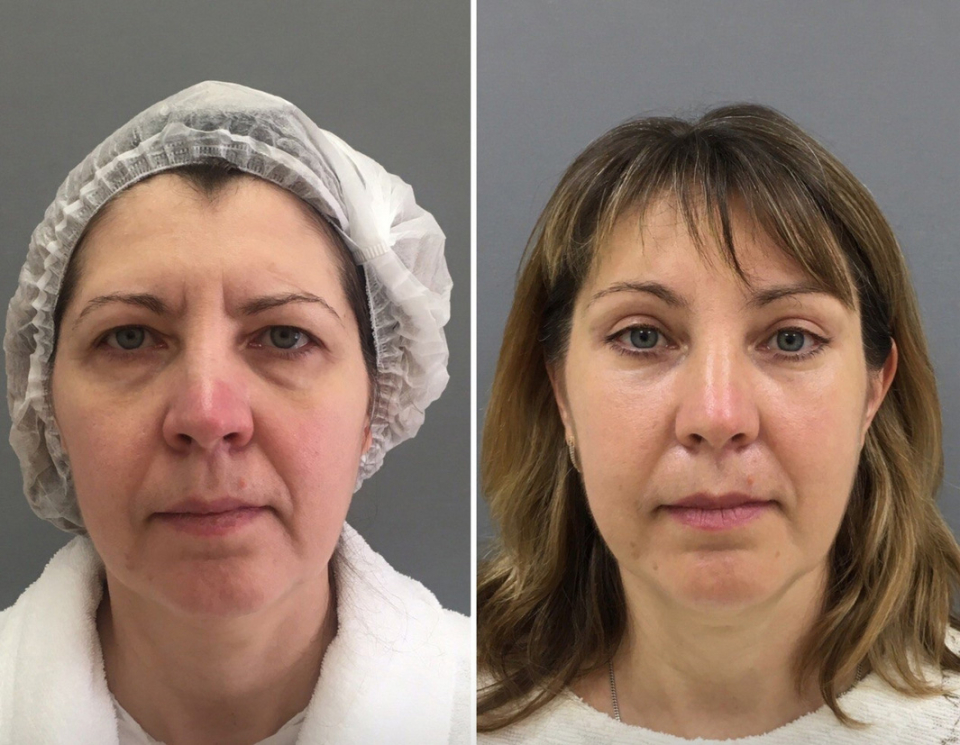 Пациентка до и после комплексной подтяжки лица у доктора Марины Четвериковой