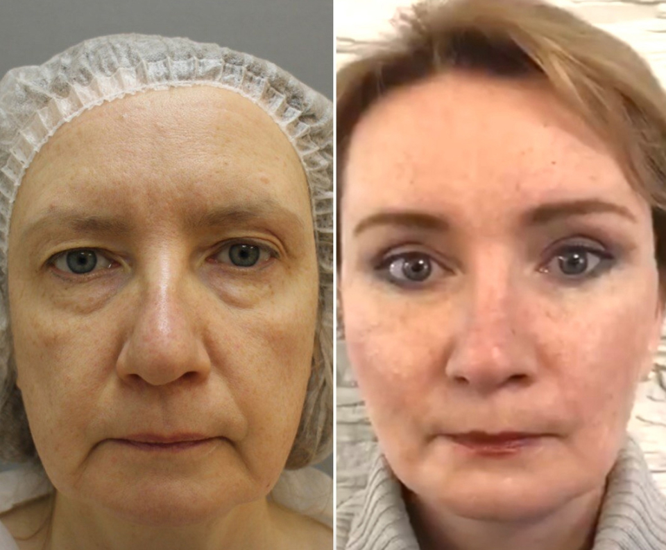 Пациентка до и после комплексной подтяжки лица у доктора Четвериковой
