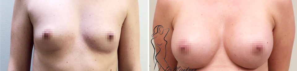 Гукас Миракян увеличение груди