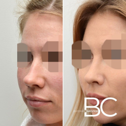 Пациентка доктора Стайсупова до и после успешной пластики носа