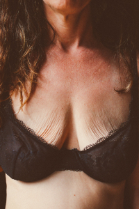 Пластика обвисшей груди