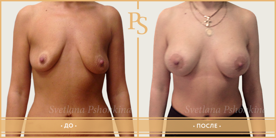 Комбинированная подтяжка с увеличением груди у доктора Светланы Пшонкиной
