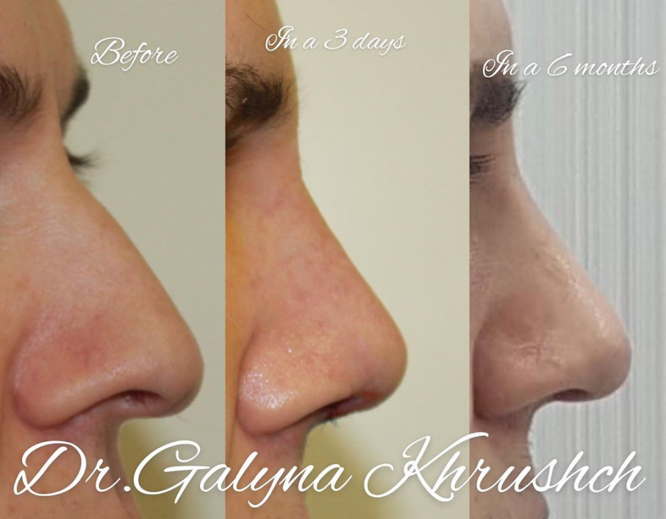 Пациент доктора Галины Хрущ до и после ринопластики