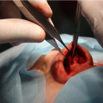 Ринопластика носа после травмы