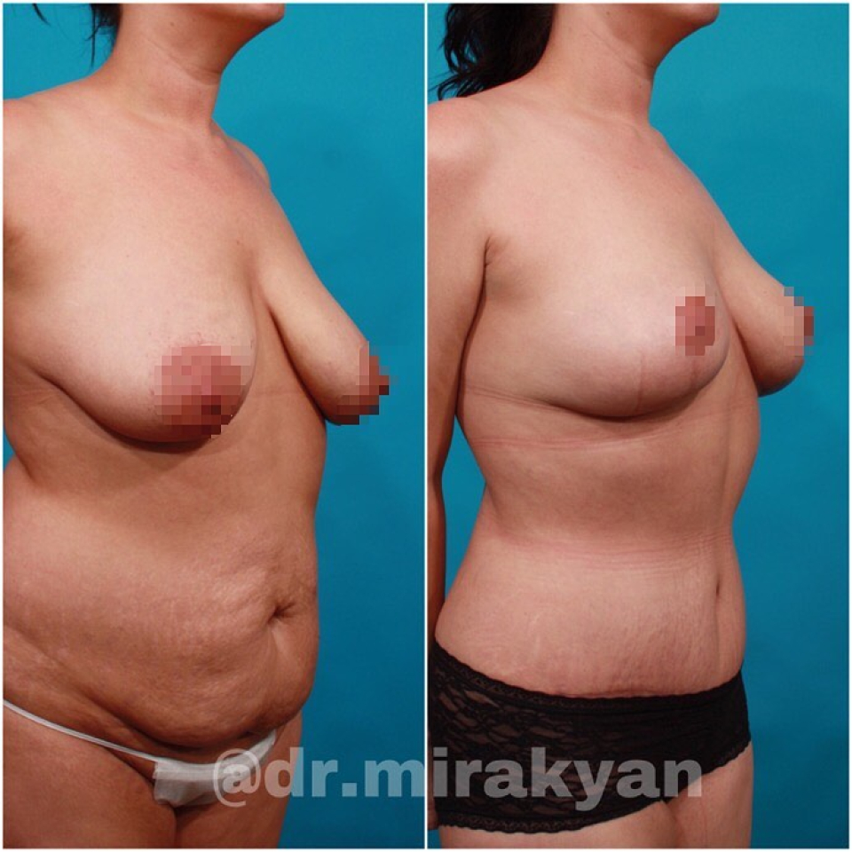 Пациентка пластического хирурга Гукаса Миракяна до и после пластики груди и живота