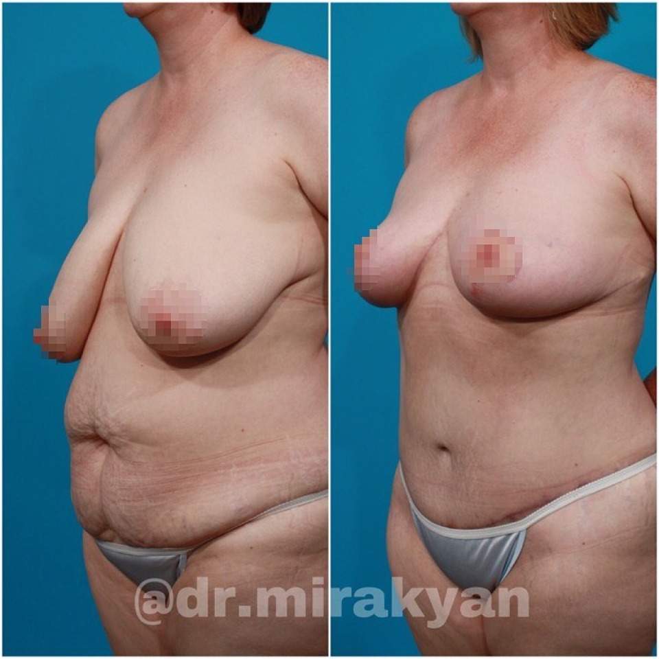 Пациентка пластического хирурга Гукаса Миракяна до и после комплексной операции
