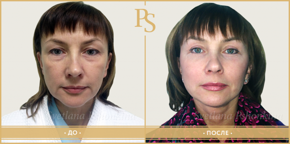 Пациентка доктора Пшонкиной до и после подтяжки лица и век