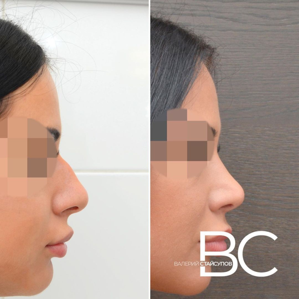 Пациентка до и после закрытой ринопластики у пластического хирурга Валерия Стайсупова